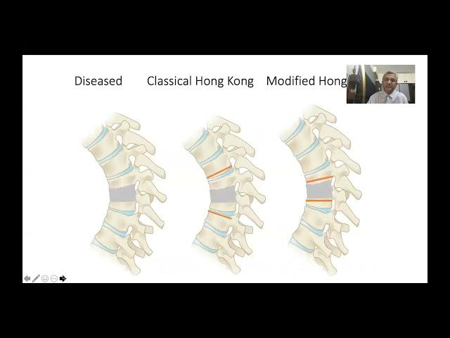 Current Trends in the Management of Spine TB - Dr Ajoy Shetty