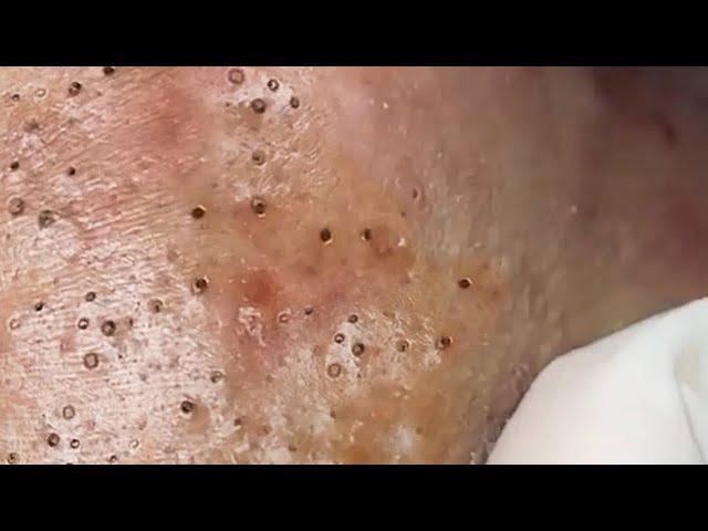 Relax Skincare Everyday with Acne Blackheads Treatment Spa #91015