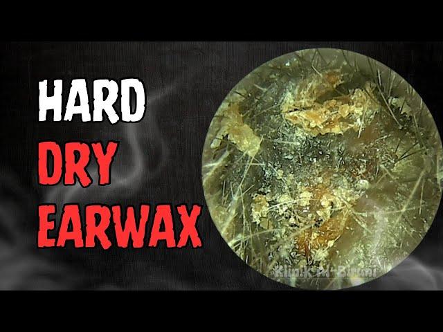 HARD Dry Earwax