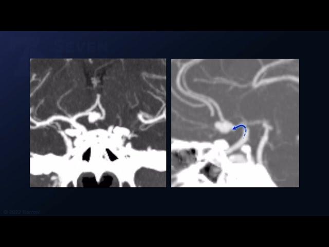 Clip Reconstruction of an Anterior Communicating Artery Aneurysm