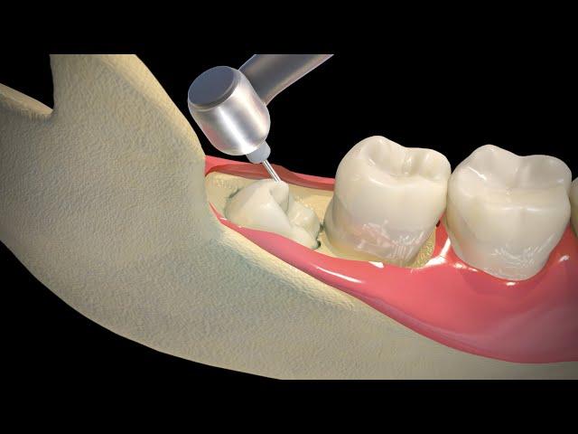 Wisdom Teeth Extraction - Step by step