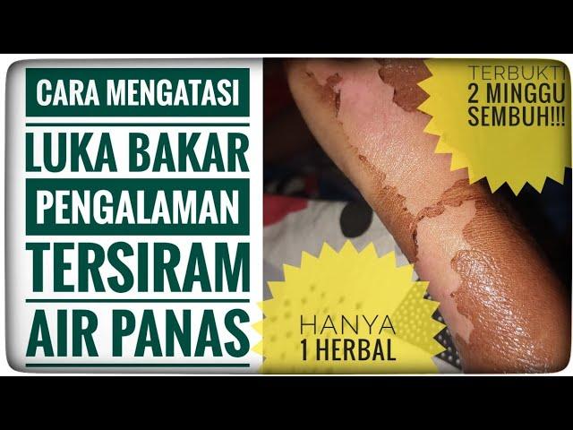 Cara Mengatasi Luka Bakar || Pengalaman Tersiram Air Panas Sembuh Dalam Waktu 2 Minggu