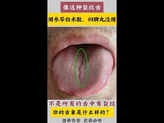 像这种裂纹舌，用参苓白术散、归脾丸没用？