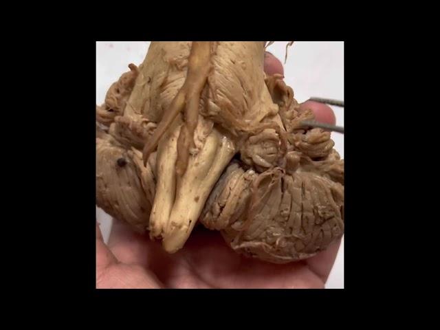 Vertebrobasilar Arterial system of Brain- vertebral artery,Basilar artery