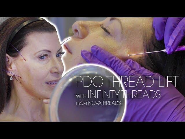 NovaThreads Infinity Thread Lift | PDO Threads for Jawline Contouring