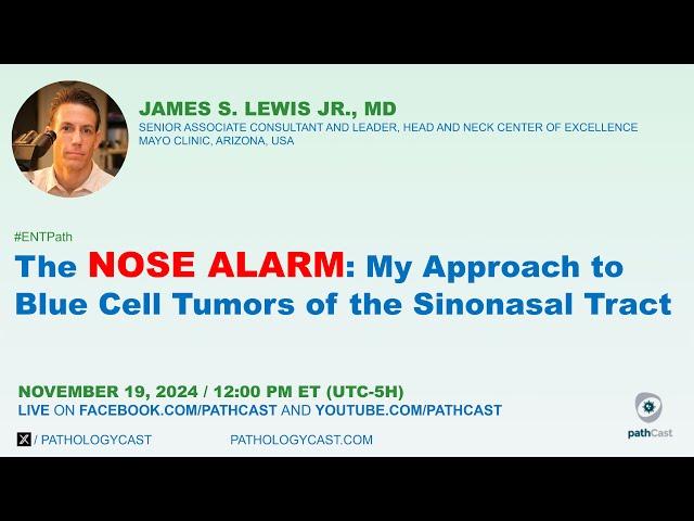 #ENTPATH The NOSE ALARM: My approach to Blue Cell Tumors of the Sinonasal Tract