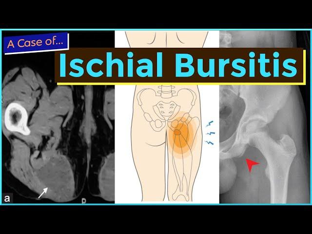 Ischial Bursitis