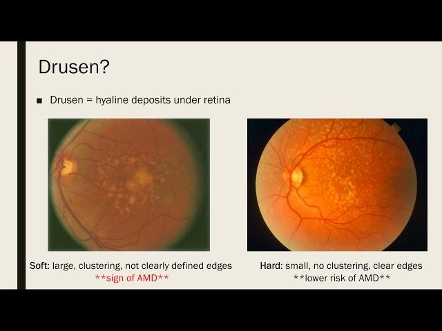 Vision Loss and Macular Degeneration