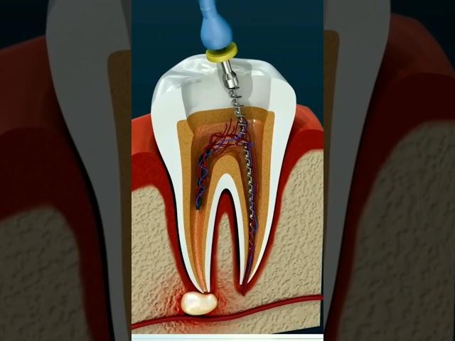 Root Canal #toothcare #canal #rootcanal #innovation #shorts #teeth