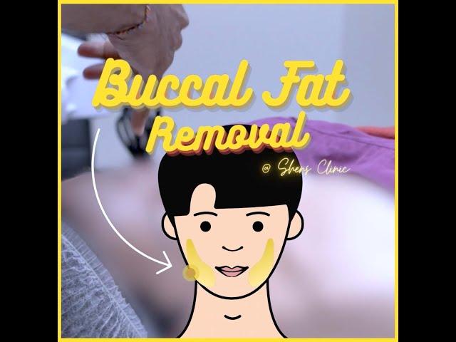 Shens Clinic | Buccal Fat Removal (Cheek Fat Reduction)