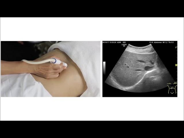 Abdominal Ultrasound Scanning Technique for the Beginner
