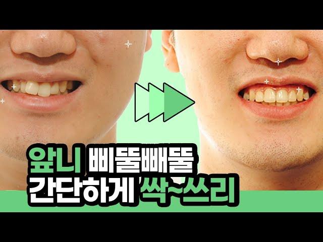 부산교정치과, 앞니 교정 전/후 확인해보세요. 예쁜미소바른이치과