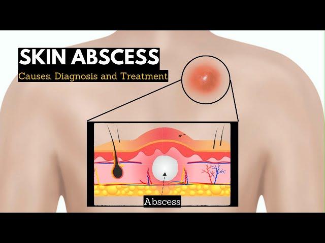 Skin Abscess, Causes, Signs and Symptoms, Diagnosis and Treatment.