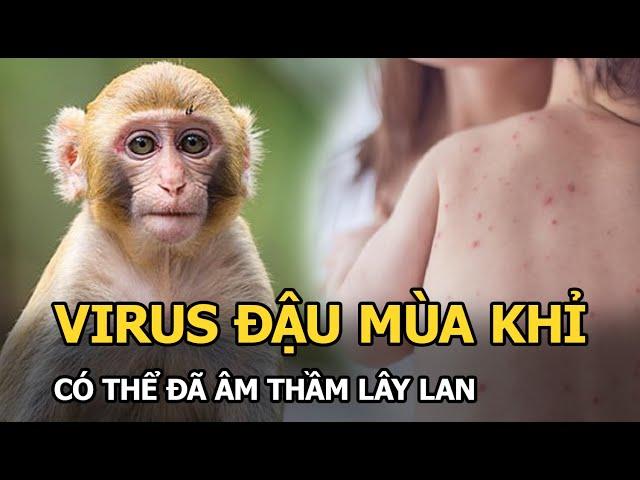 CẢNH BÁO: Virus đậu mùa khỉ có thể đã âm thầm lây lan!