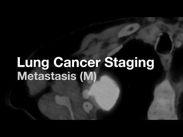 Lung Cancer Staging - Metastasis (M)