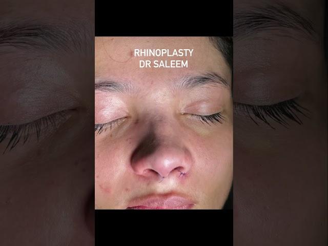 Rhinoplasty surgery for nose asymmetry.Ultrasonic rhinoplasty by dr Saleem.#rhinoplasty #nosejob