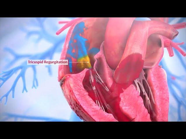 Tricuspid Valve Repair - Triluminate Clinical Trial