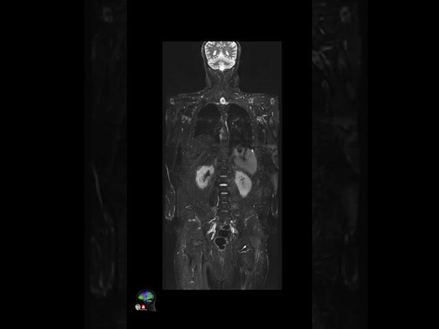 MRI – Whole Body Imaging w/Deep Resolve