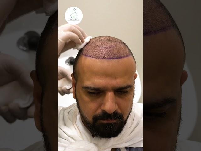 Hair wash after hair transplant procedure #shorts #hairwash