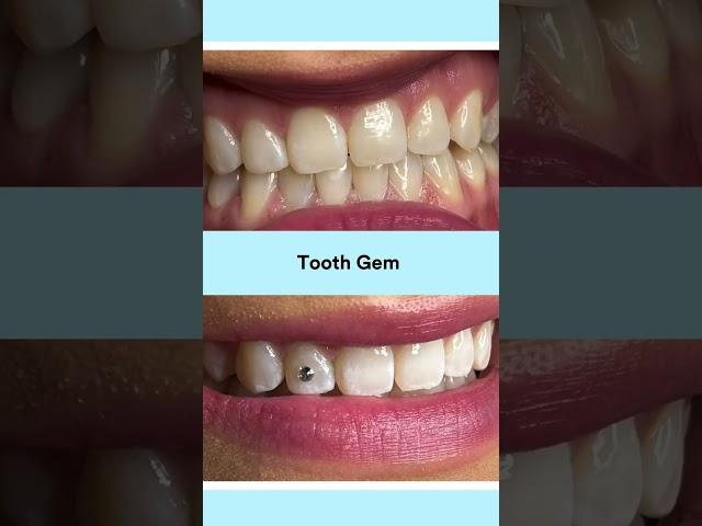 Tooth gems before and after #thetoothlady