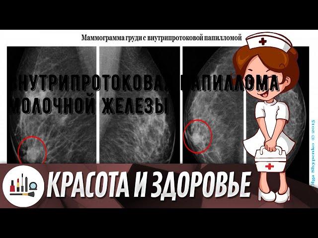 Внутрипротоковая папиллома молочной железы