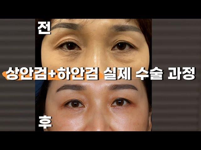 사진으로 보는 상안검 하안검 수술 전후 과정 [연세미도 성형외과]