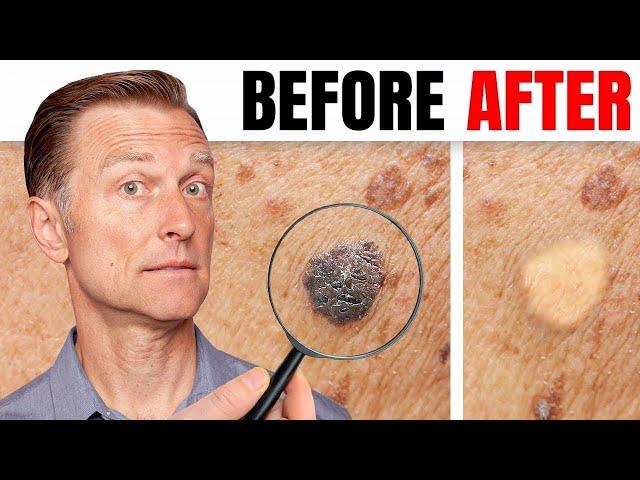 How to Remove Skin Tags and Warts Overnight - Dr. Berg Explains