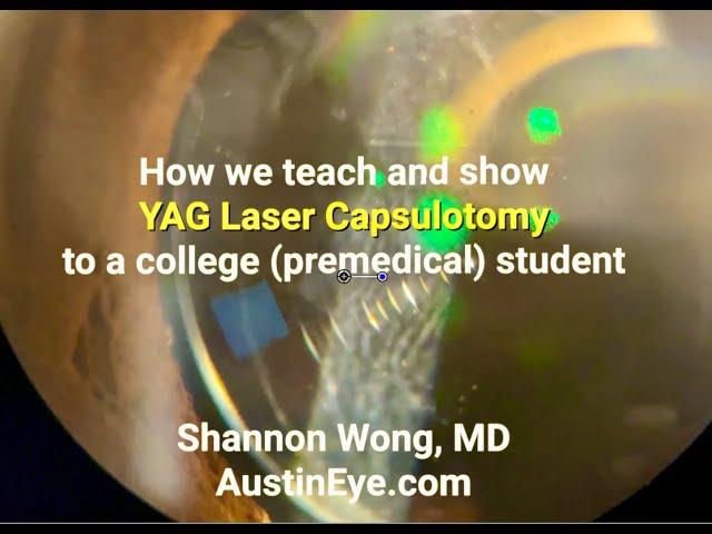 How we teach college students about YAG capsulotomy.