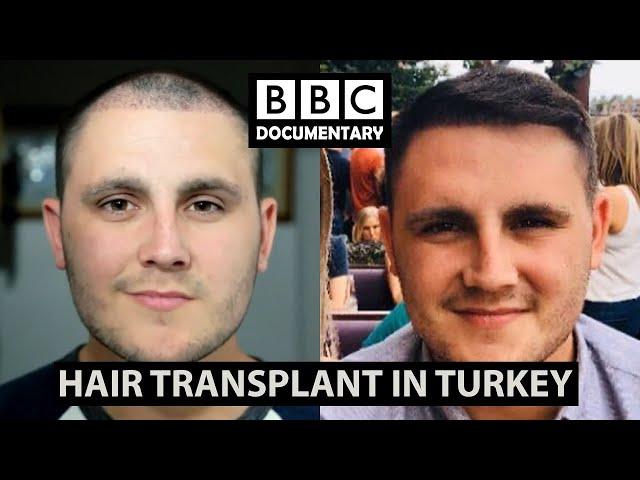 BEST HAIR TRANSPLANT CLINIC IN TURKEY | SMILE HAIR CLINIC | REAL PATIENT RESULT | ISTANBUL & UK