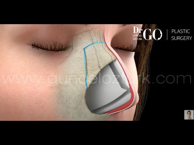 Let Down & Push Down Preservation Rhinoplasty, Nose Job Operation. Guncel Ozturk, M.D. #DRGO