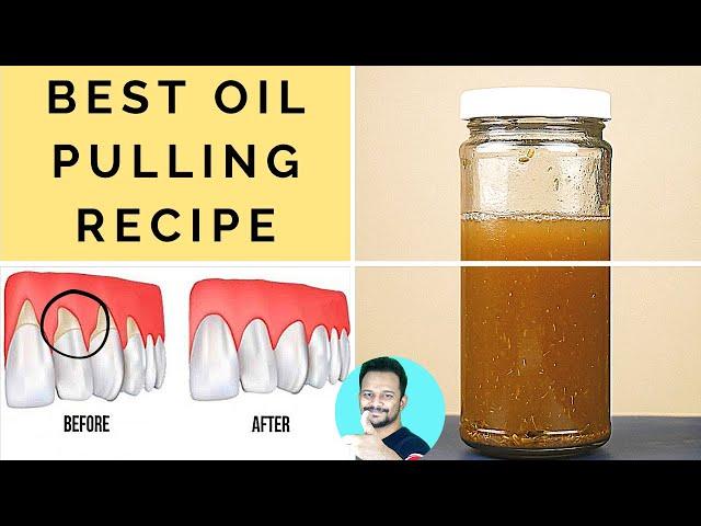 Heal Gingivitis, Receding Gums, Prevent Plaque & Tartar (World’s Best Oil Pulling Recipe)