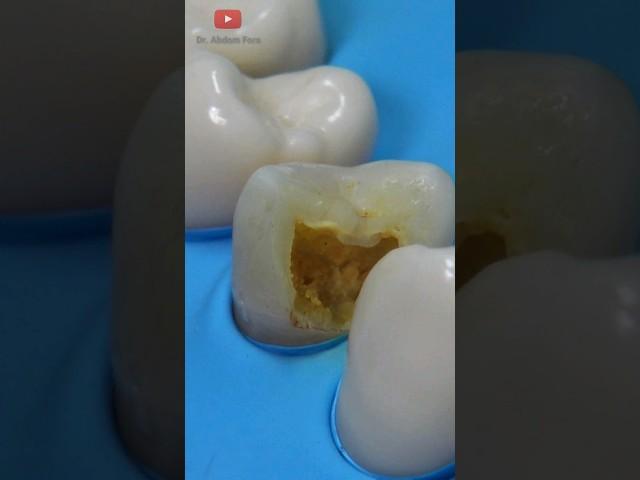 Tooth decay reached the nerve #restoration