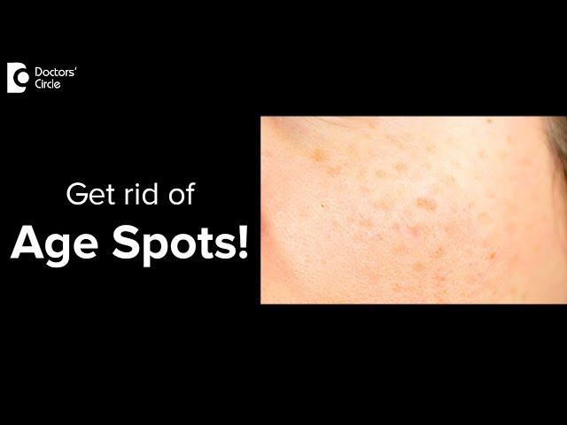 What are age spots? Can you get rid of age spots? - Dr. Urmila Nischal