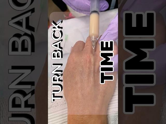 Turn back time with hand rejuvenation using Renuva! #hand #medspa #renuva #rejuvenation #aesthetics