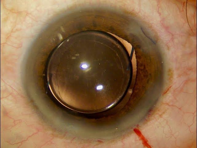 A Soft Cataract and a Multipiece IOL