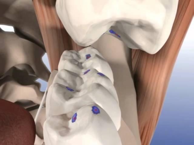 Checking the occlusion using the 2 step method