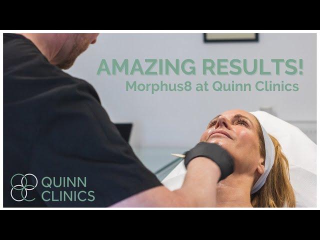 Non-Surgical Facelift? The Morpheus8 Device at Quinn Clinics Bristol! | Inmode Morpheus8