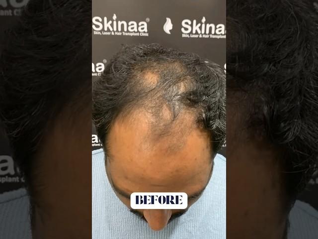 Best Hair Transplant Treatment in Jaipur | Real Patient Before & After at Skinaa Clinic #shorts