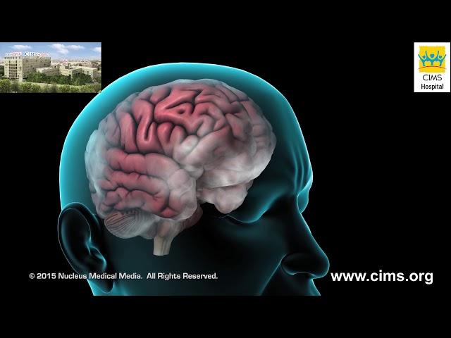 Fibromialgia – CIMS Hospital