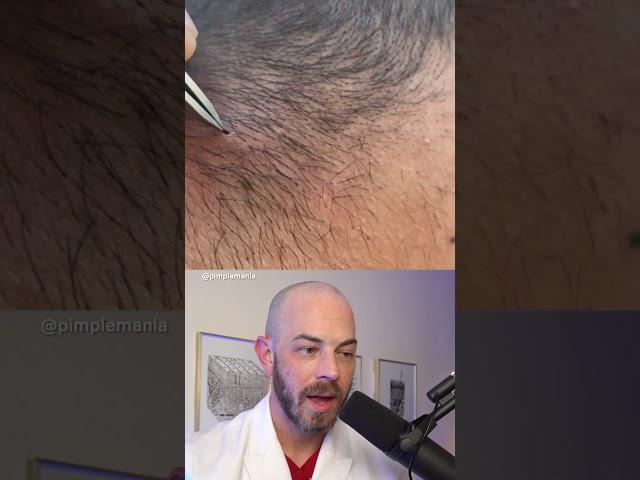 Derm reacts to BIG ingrown hair! #dermreacts #doctorreacts #ingrownhair