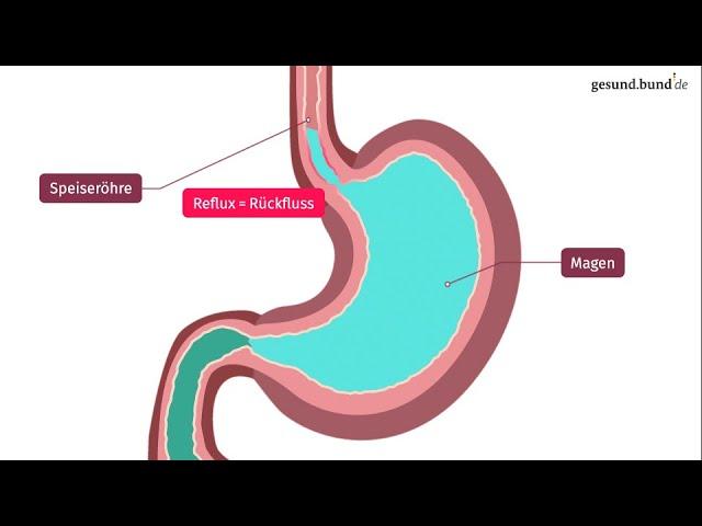 Was ist die Refluxkrankheit?