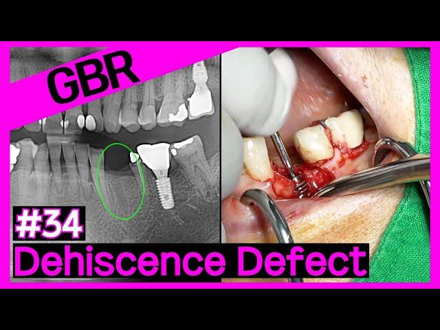[Online Surgery] Simultaneous Implant Placement and GBR Using OssBuilder