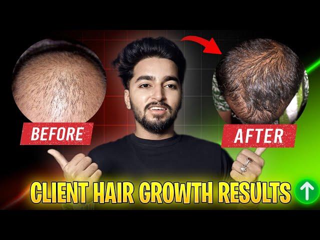 Hair Regrowth Result  Before After Client 1