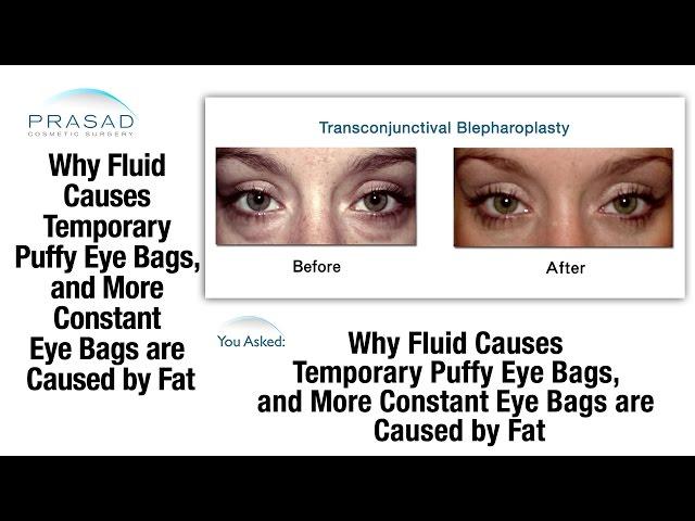 How Fluid Causes Temporary Puffy Eyes, and Why Constant Eye Bags are Caused by Fat