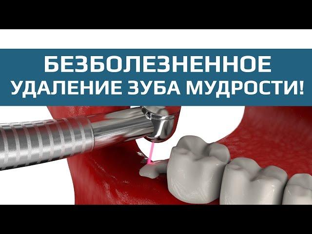 Удаление зуба мудрости с осложнениями. Удаление ретинированного и дистопированного зуба