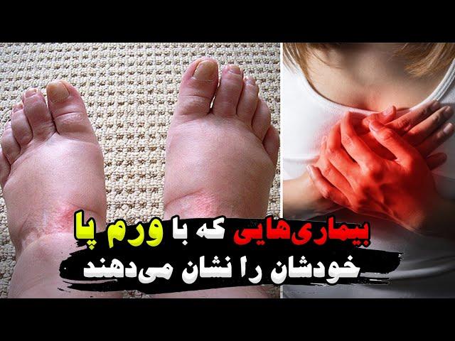 بیماری هایی که با ورم پا خودشان را نشان می‌دهند