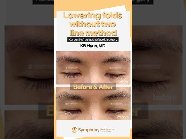 A revision surgery without the "two line method"? Don't get a new eyelid scar that you don't need!