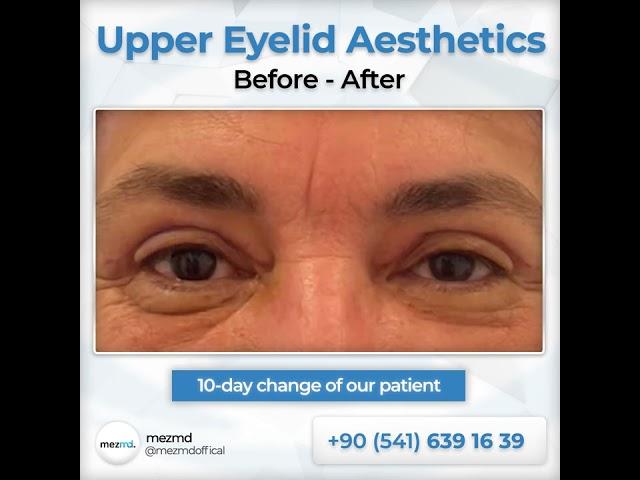 Upper Eyelied (Blepharoplasty) Surgery - Before & After | mezMD Health Tourism Agency