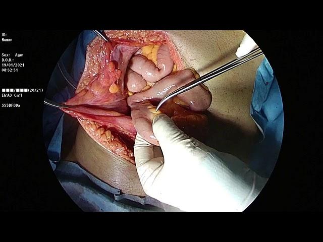 Technique of completely diverted tube ileostomy