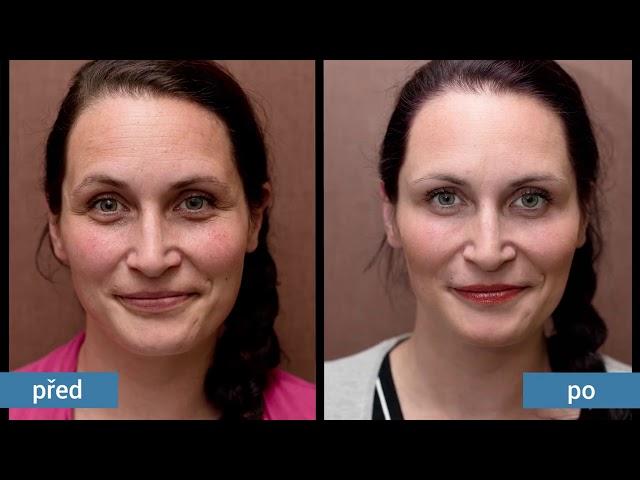 Anti-aging proměny Perfect Clinic Dermatology - spot